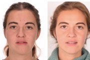 Asimetría facial severa asociada a desviación mandibular hacia la izquierda. Corrección con cirugía ortognática bimaxilar con mandíbula grande.