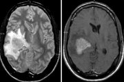 Linfoma cerebral, un tipo de tumor raro, poco frecuente y difícil de diagnosticar de manera temprana