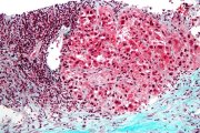 Células cancerigenas