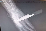 Radiografía de la mano del agente de la Policía Nacional apuñalado en Baza (Granada)

REMITIDA / HANDOUT por UNIÓN FEDERAL DE POLICÍA (UFP)
Fotografía remitida a medios de comunicación exclusivamente para ilustrar la noticia a la que hace referencia la imagen, y citando la procedencia de la imagen en la firma
18/3/2026