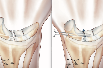 Rotura del ligamento escafosemilunar e inmovilización de la articulación con agujas para curar los ligamentos.