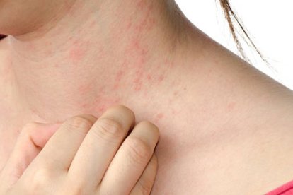 Dermatitis atópica