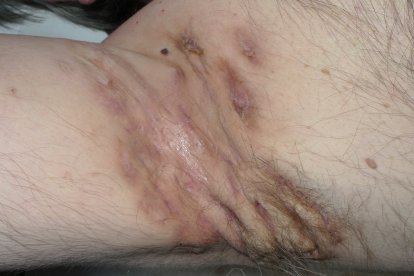 hidradenitis supurativa