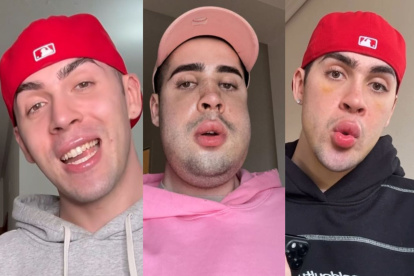 El influencer Jorge Cyrus en su antes (i), durante (c) y después (d) de su operación facial