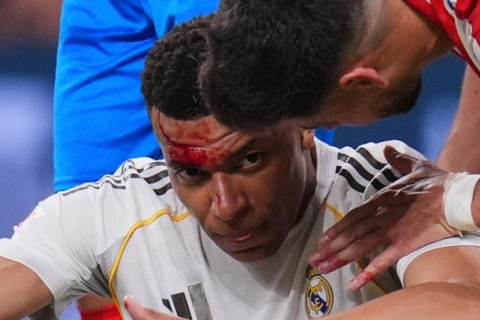 Mbappé, sangrando tras el codazo de Vitor Reis