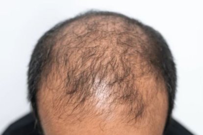 Alopecia