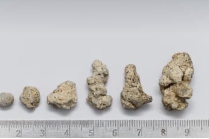 Piedras en los riñones