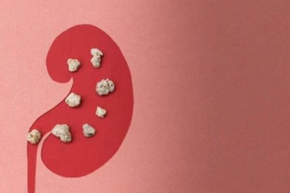 Piedras en el riñón