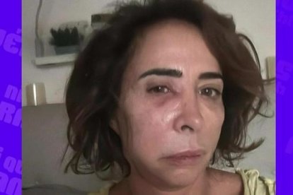Finalmente María Patiño accedió a mostrar una imagen de cómo tiene el rostro por culpa del flemón que sufre.
