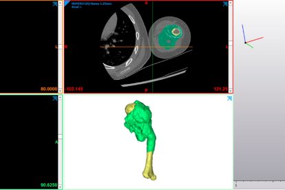 Imagen médica original del paciente (TC), segmentación de estructuras anatómicas y tumorales húmero y osteosarcoma