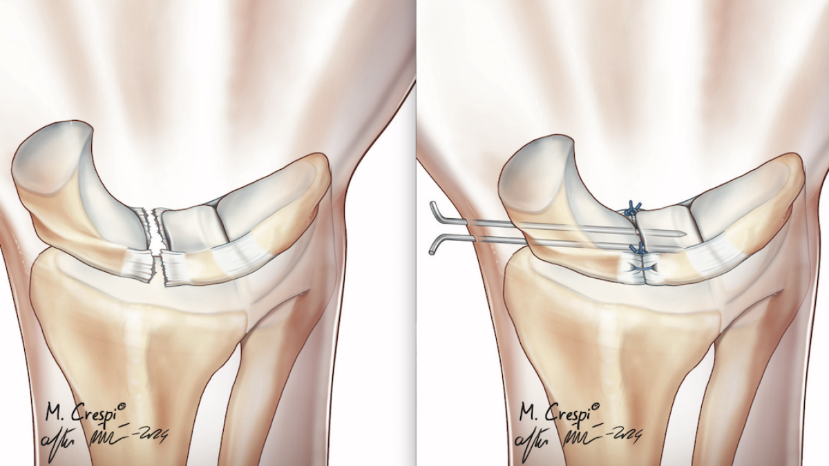 Rotura del ligamento escafosemilunar e inmovilización de la articulación con agujas para curar los ligamentos.