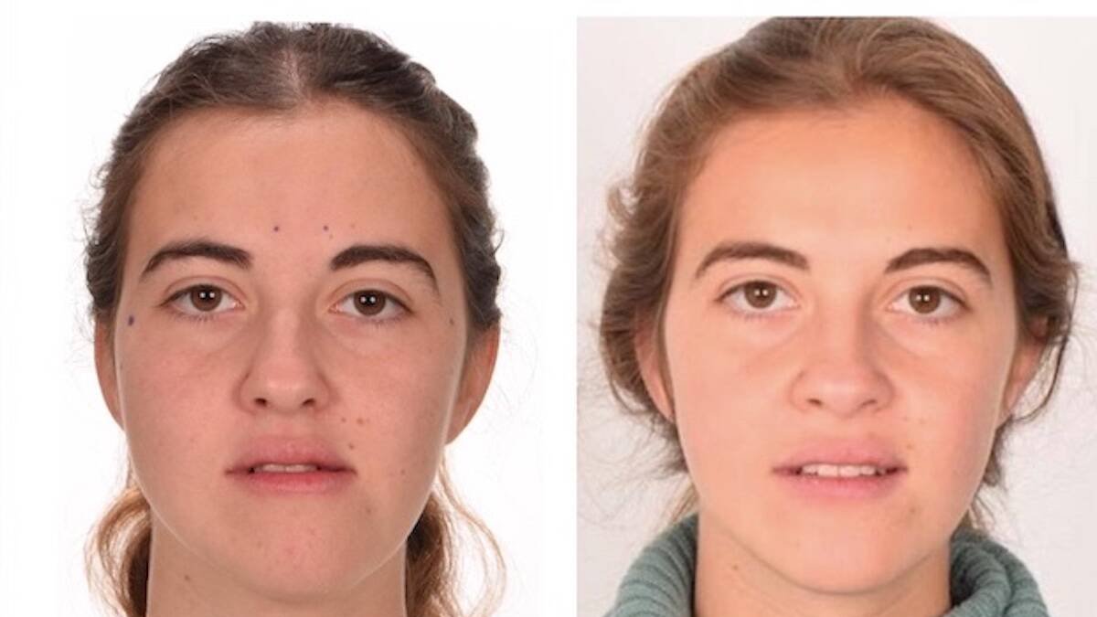 Asimetría facial severa asociada a desviación mandibular hacia la izquierda. Corrección con cirugía ortognática bimaxilar con mandíbula grande.