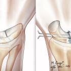 Rotura del ligamento escafosemilunar e inmovilización de la articulación con agujas para curar los ligamentos.