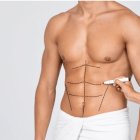 La cirugía del six-pack, o ‘tableta de chocolate’