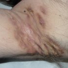 hidradenitis supurativa