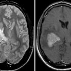 Linfoma cerebral, un tipo de tumor raro, poco frecuente y difícil de diagnosticar de manera temprana