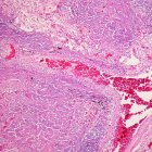 Archivo - Tuberculosis.