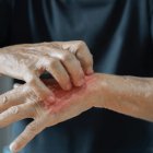 Hombre rascando su mano enrojecida por el picor