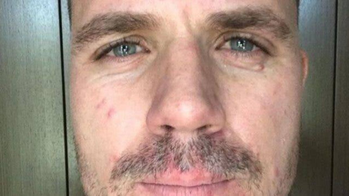 Rosácea, la enfermedad de moda. Mira la famosa que se une a Dani Martín: “A mí sí me molesta”