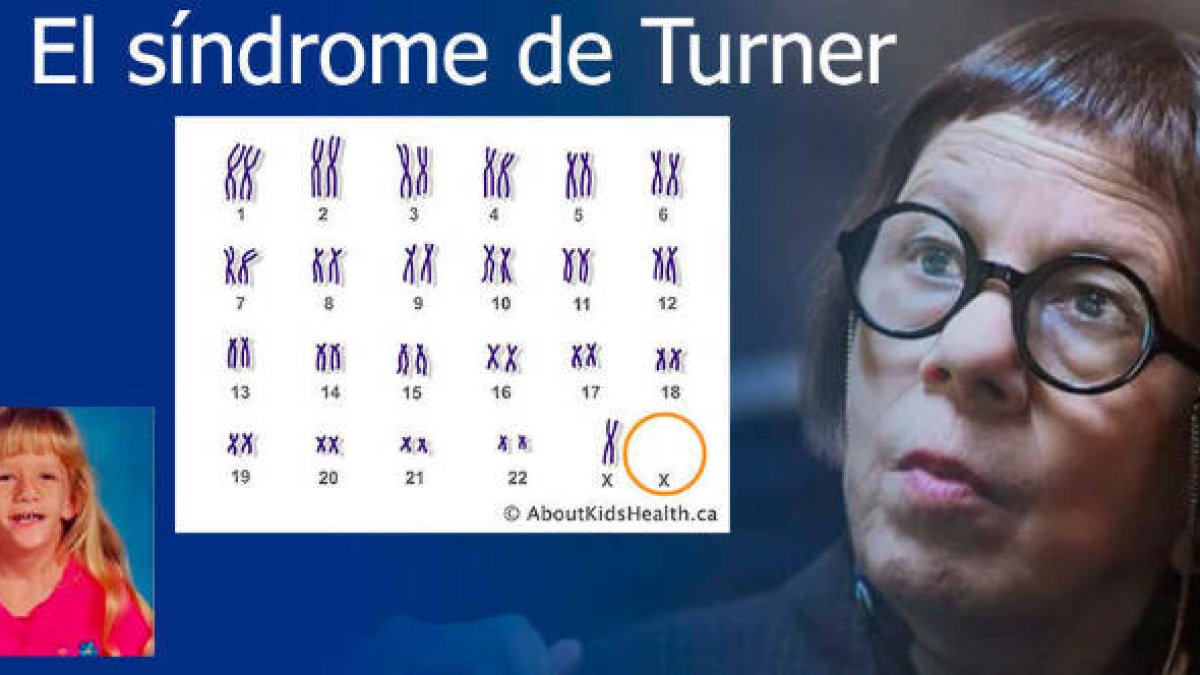 El síndrome de Turner