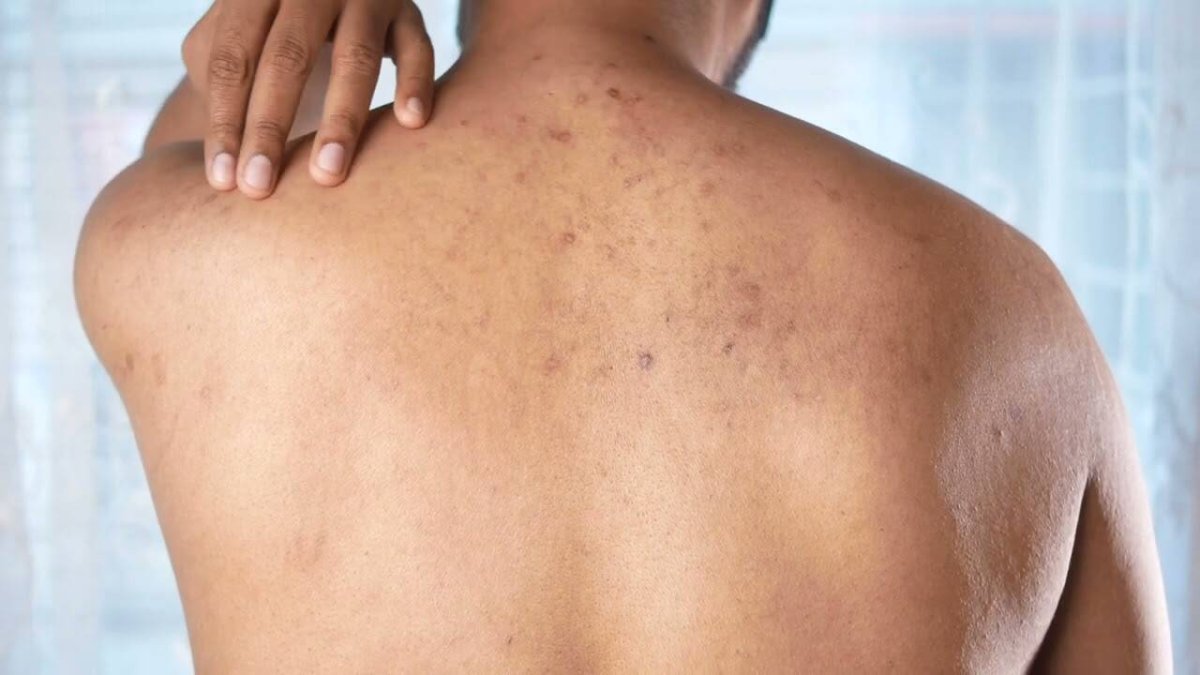 Las consultas médicas abarrotadas por las manchas solares