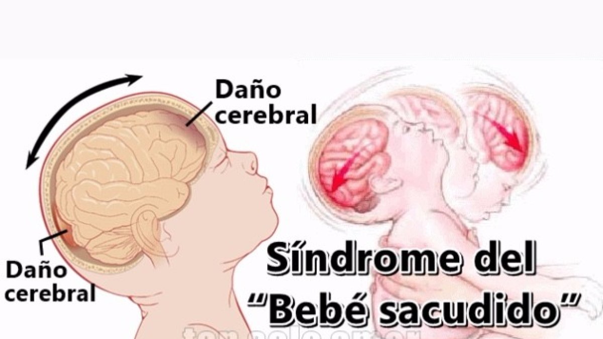 Dos años de prisión por zarandear a su bebé y causarle parálisis cerebral