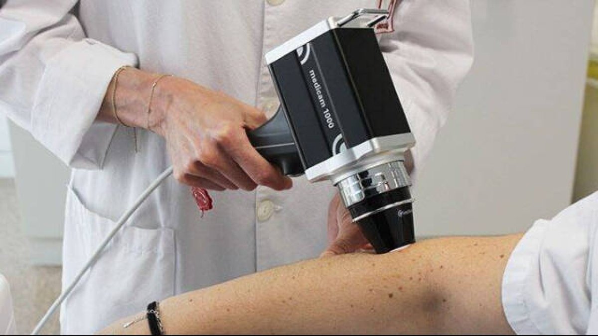 El servicio de Dermatología del Hospital del Vinalopó experimenta un gran avance en la detección precoz del cáncer de piel