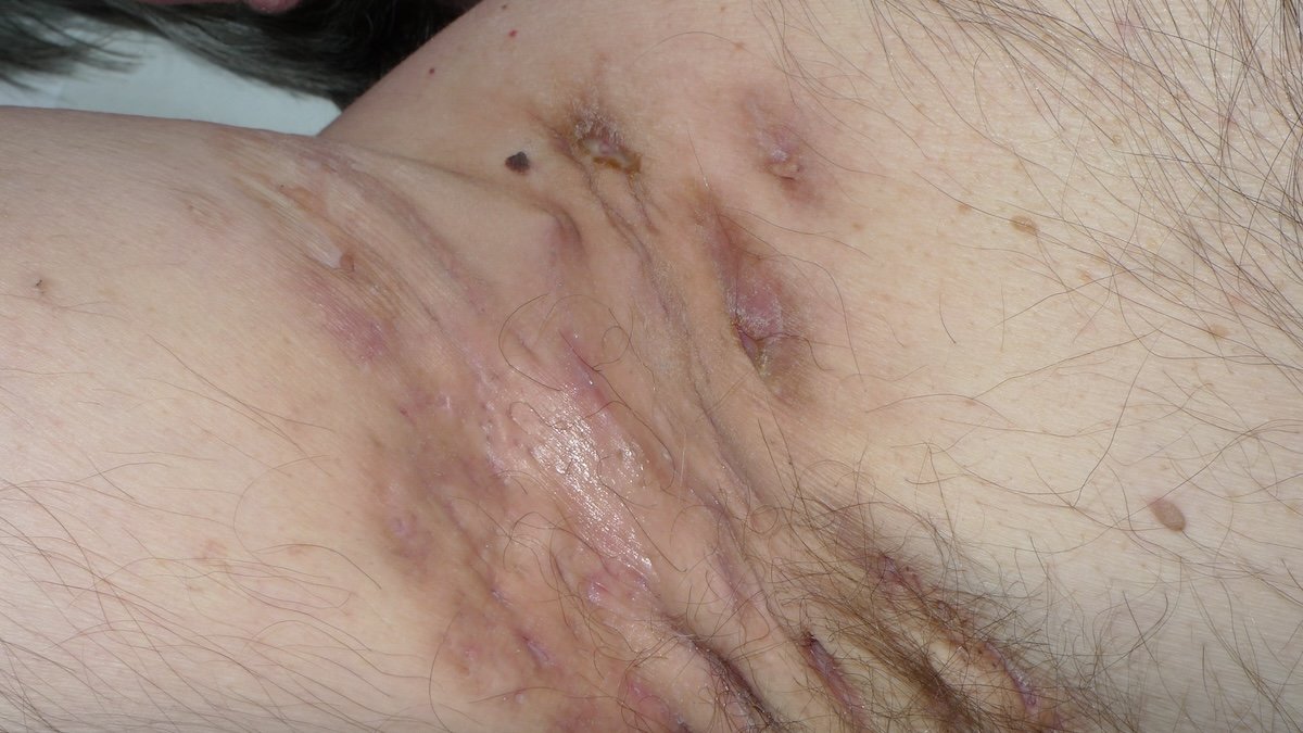 Hidradenitis supurativa
