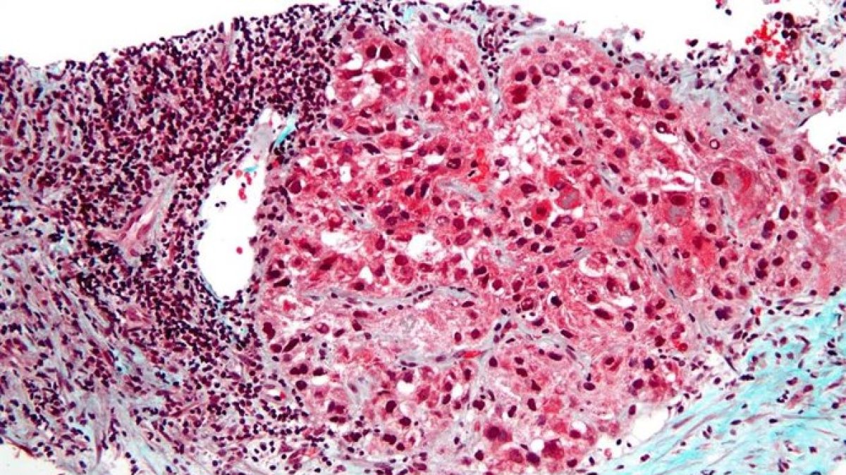 El cáncer que mata en silencio: las cifras que nadie quiere mirar de una pandemia silenciosa