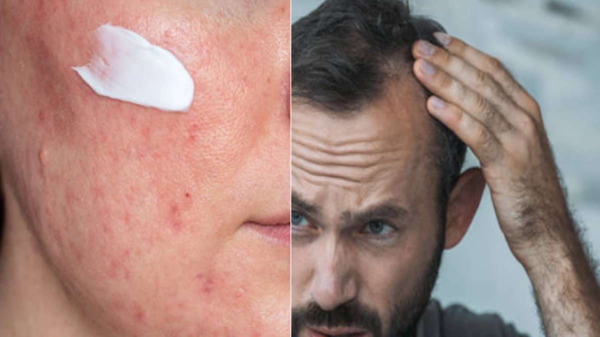 Nuevo tratamiento acné y alopecia