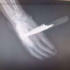 Radiografía de la mano del agente de la Policía Nacional apuñalado en Baza (Granada)

REMITIDA / HANDOUT por UNIÓN FEDERAL DE POLICÍA (UFP)
Fotografía remitida a medios de comunicación exclusivamente para ilustrar la noticia a la que hace referencia la imagen, y citando la procedencia de la imagen en la firma
18/3/2026