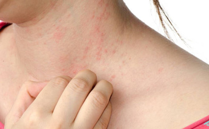 Dermatitis atópica