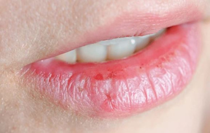 Labios secos