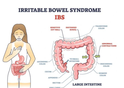 Síndrome del intestino irritable