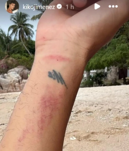 Kiko Jiménez mostró las heridas que le quedaron tras su percance con dos 