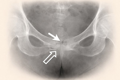 Simulacion de una radiografía de osteomielitis púbica